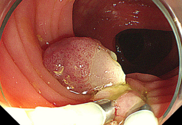大腸ポリープ